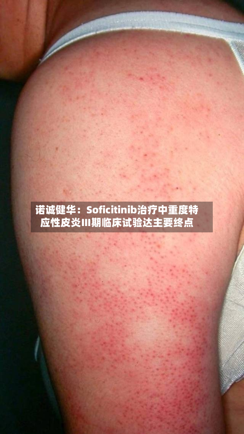 诺诚健华:Soficitinib治疗中重度特应性皮炎Ⅲ期临床试验达主要终点